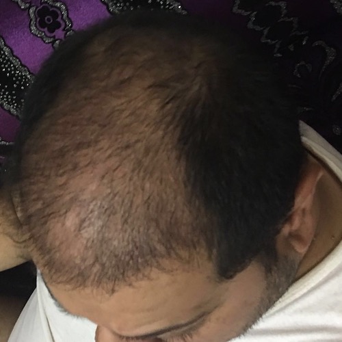 تجربة زراعة الشعر بتركيا في اثيكانا كلينك ( تحديث الشهر السادس ) P_443v6vwm4