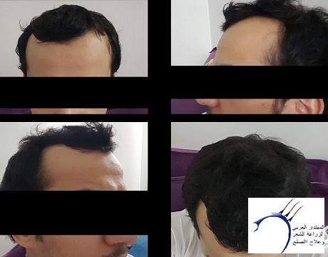 تجربة 3 اصدقاء لزراعة الشعر في تركيا في وقت واحد ايست اثيكا P_572jv2rv5